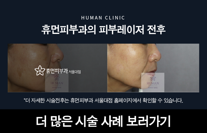 봉천동피부과 기미잡티제거의 핵심 관련 이미지 9
