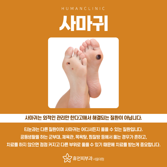 사당역피부과, 사마귀 관리 꼼꼼하게 하려면? 관련 이미지 2