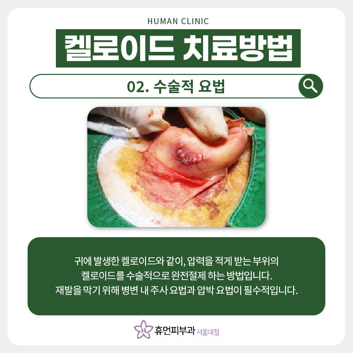 켈로이드피부과 최고의 치료 효과 보장하는 피부과? 관련 이미지 5