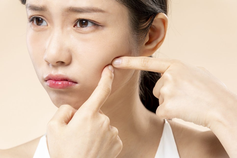 여드름이 생겼을 때 흉터를 줄이려면 어떻게 해야 할까? 관련 이미지 7