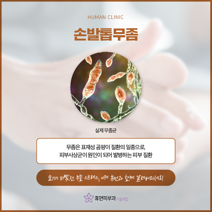 무좀치료법 제대로 알아보고 싶다면? 관련 이미지 2