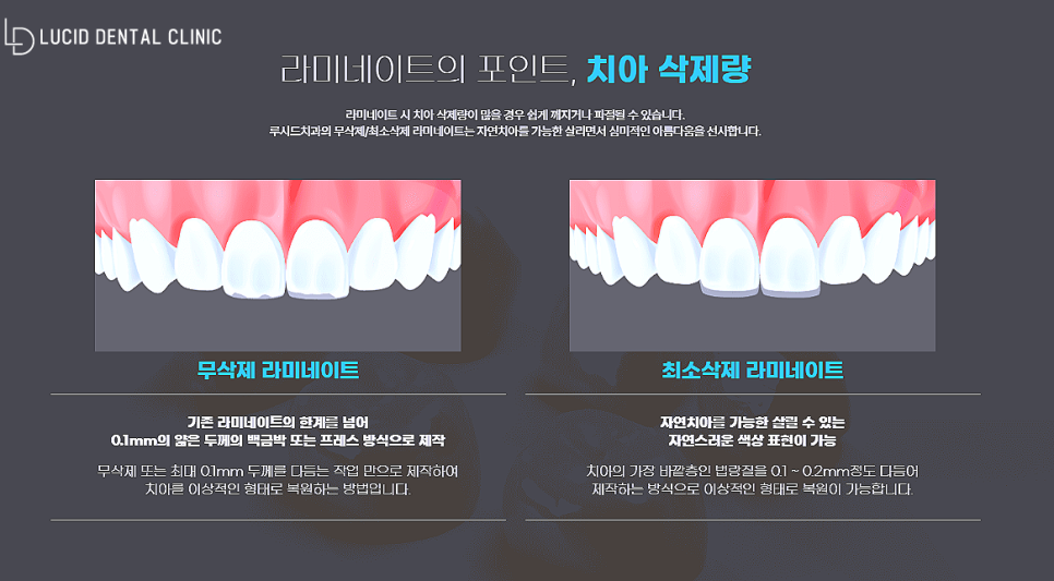 앞니 치아 교정없이 하루만에 예뻐질 수 있는 이유 - 논현역 치과 라미네이트 시술후기 관련 이미지 6