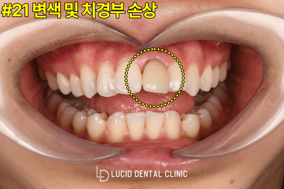 논현동 치과 에서 교정 없이, 라미네이트 시술 로 뻐드렁니 개선해 드린 사례 관련 이미지 2