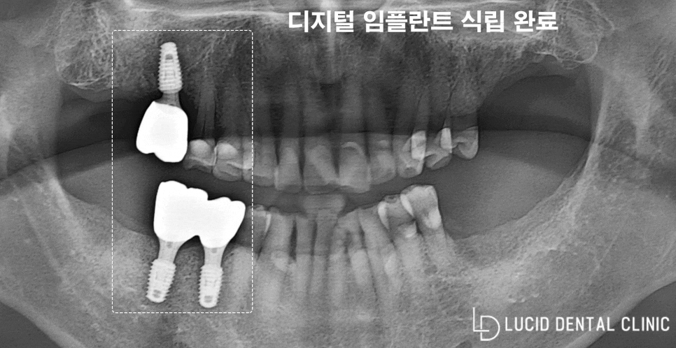 비어있는 어금니 치아와 소실된 기능, 강남역 치과 임플란트 수술로 회복할 수 있었던 이유 관련 이미지 3
