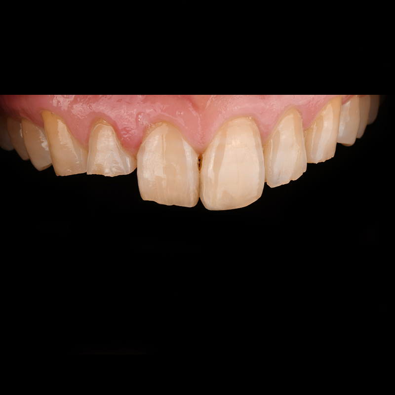 Can Cracked and Stained Front Teeth Be Improved Naturally? image 1