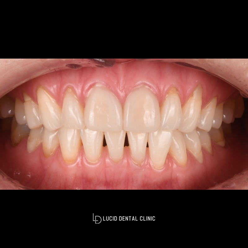If There Is a Gap Between the Front Teeth? A Case Improved with Lucinate image 1