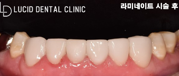 심각한 치아 변색과 마모증, 논현역 치과 에서 라미네이트 로 치료가 가능한 곳은? 관련 이미지 4