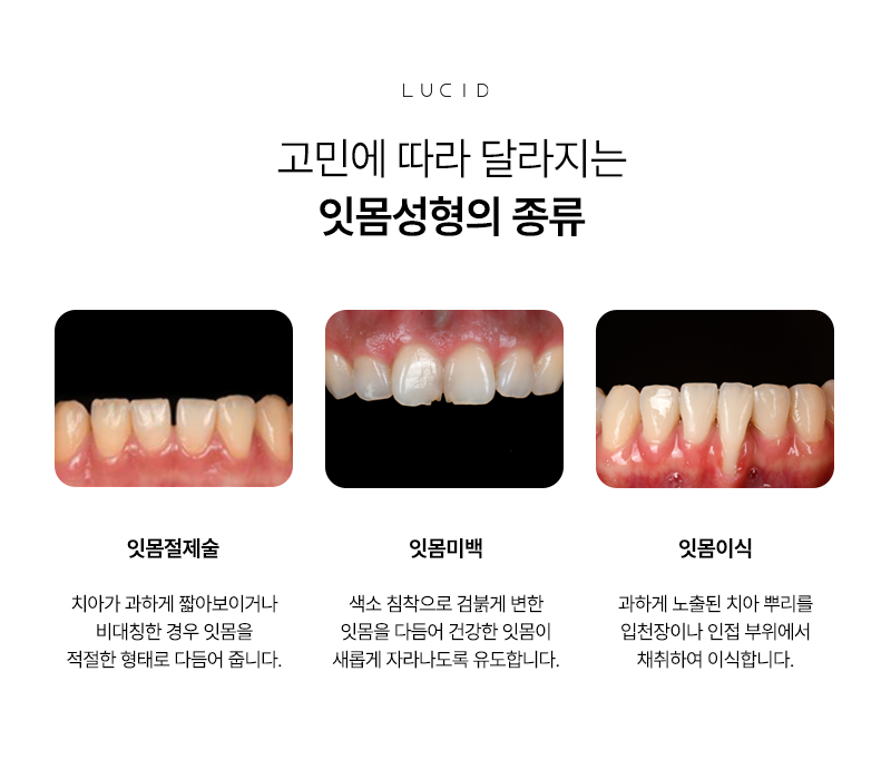 Seolleung Dental Clinic: Do Your Gums Show Too Much When You Smile? image 4