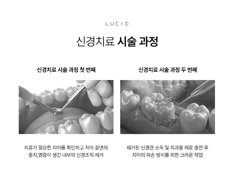 Nonhyeon-dong Dental Clinic Root Canal Treatment: Another Choice for Saving a Tooth image 6
