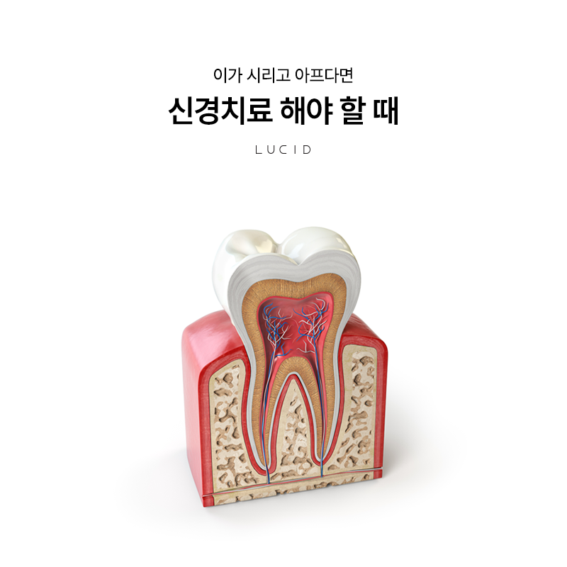 선릉역치과 신경치료 통증부터 치료 과정까지 관련 이미지 1