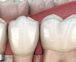 역삼동 치과 임플란트 수술 후 부작용 및 통증 원인, 해결 방법은? 관련 이미지 2