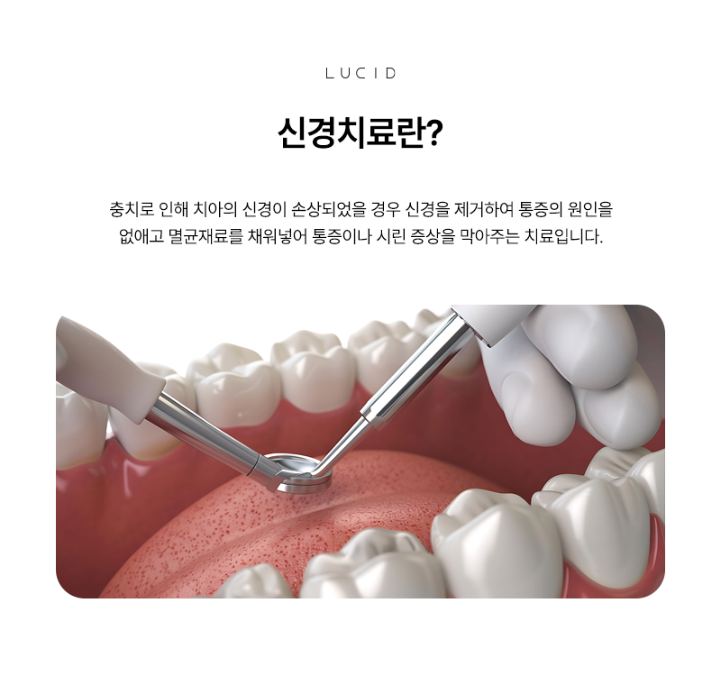 선릉역치과 신경치료 통증부터 치료 과정까지 관련 이미지 2