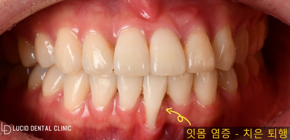 강남역 치과 추천 -  잇몸 염증으로 심하게 내려간 아래턱 앞니 치아, FGG(이식 성형술) 동반한 라미네이트 시술 후기 관련 이미지 1