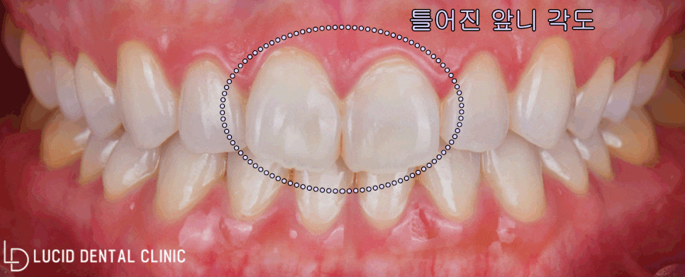 삐뚤어지고 틀어진 앞니 치아, 논현동 치과 라미네이트 시술 로 하루만에 해결 가능 관련 이미지 1