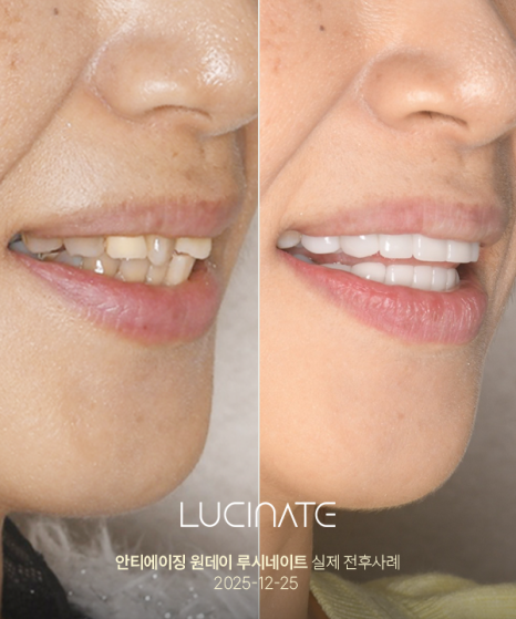 Gangnam Dental Clinic Lucinate for a Younger Smile image 4