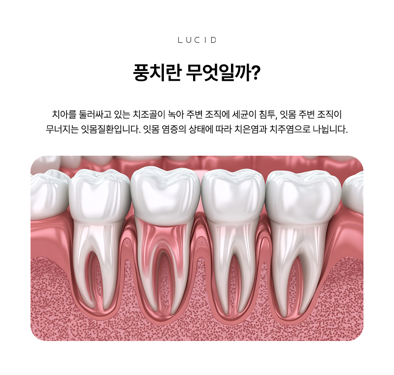 언주역치과 풍치 예방의 핵심 스케일링과 올바른 칫솔질 관련 이미지 2