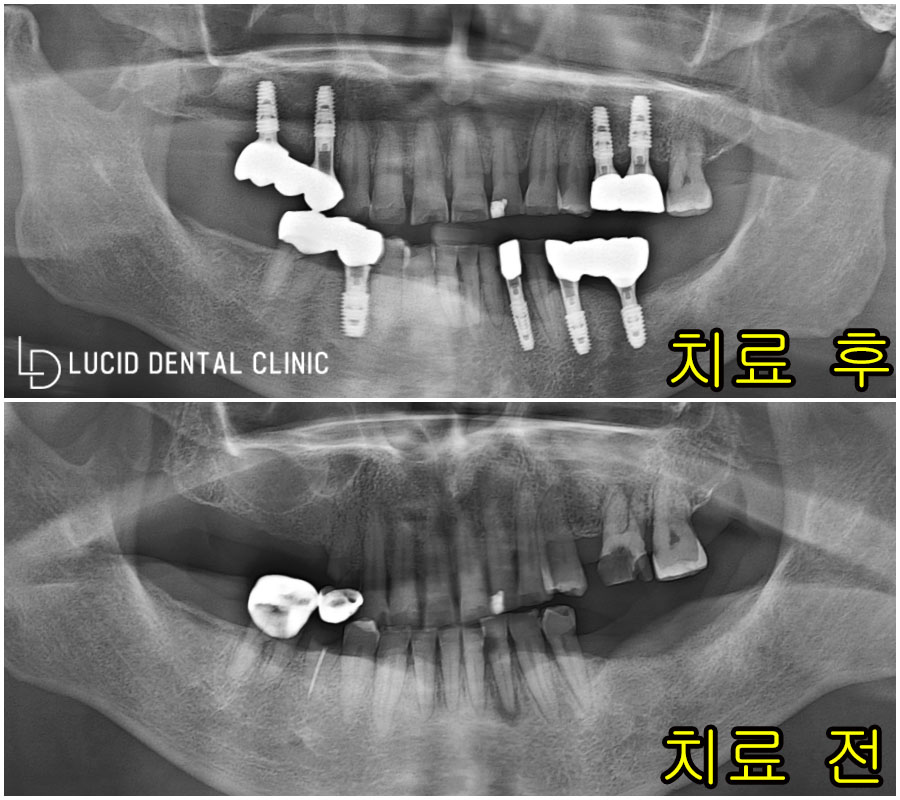 다수의 치아 상실, 임플란트 잘하는 논현동 치과 치료로 구강 건강 되찾아드렸습니다. 관련 이미지 5