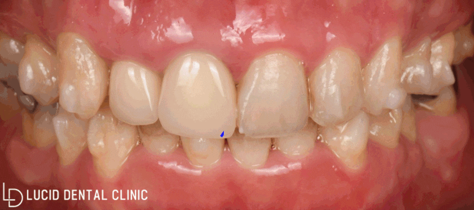 연예인 치아처럼 바뀌는 논현동 치과 최소삭제 라미네이트 시술 후기 관련 이미지 4