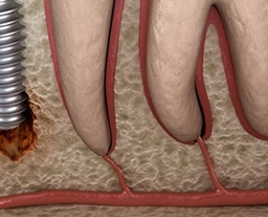 역삼동 치과 임플란트 수술 후 부작용 및 통증 원인, 해결 방법은? 관련 이미지 4