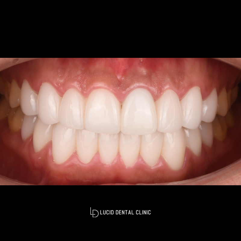 Laminates Retreatment: A Case That Changed from Unnatural to Natural image 2