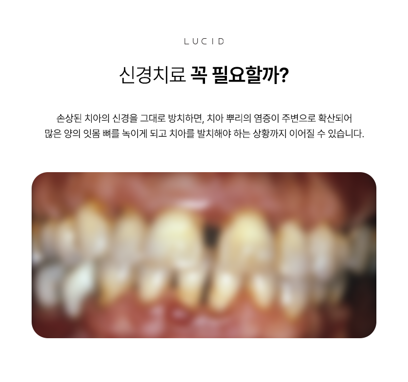 선릉역치과 신경치료 통증부터 치료 과정까지 관련 이미지 3