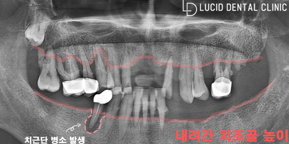 전체 임플란트 와 틀니 중 고민된다면? - 신논현역 루시드 치과 사례 소개 관련 이미지 2