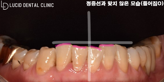 "앞니가 벌어져서 너무 보기 싫어요." 정중이개로 고민 중이던 환자분, 신논현역 치과 에서 라미네이트 로 해결해 드린 사례 관련 이미지 2
