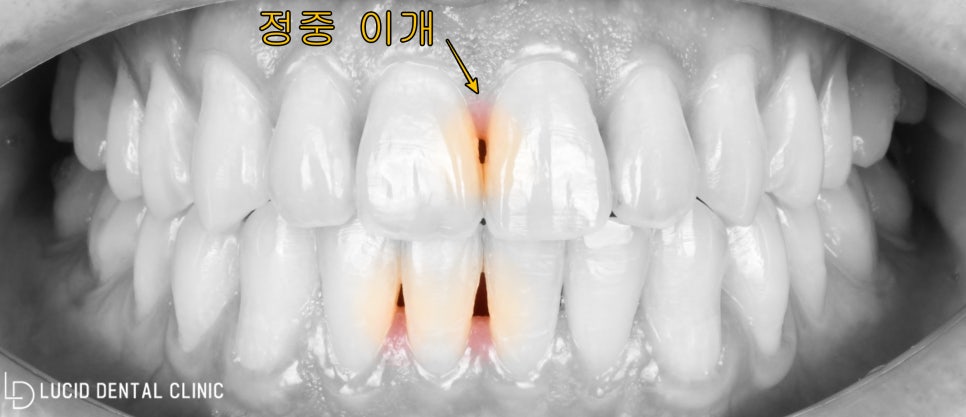 "치아 사이 거뭇한 공간, 알고 보니 이것?" 역삼동 치과 앞니 라미네이트 하루 만에 가능해요! 관련 이미지 1