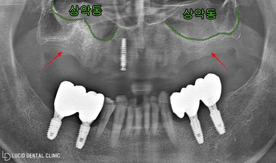 소실된 어금니 치아, 신논현역 치과 에서 틀니 없이 임플란트 수술 로 해결하기 관련 이미지 1