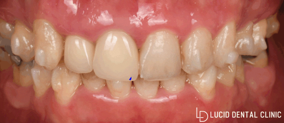 연예인 치아처럼 바뀌는 논현동 치과 최소삭제 라미네이트 시술 후기 관련 이미지 2