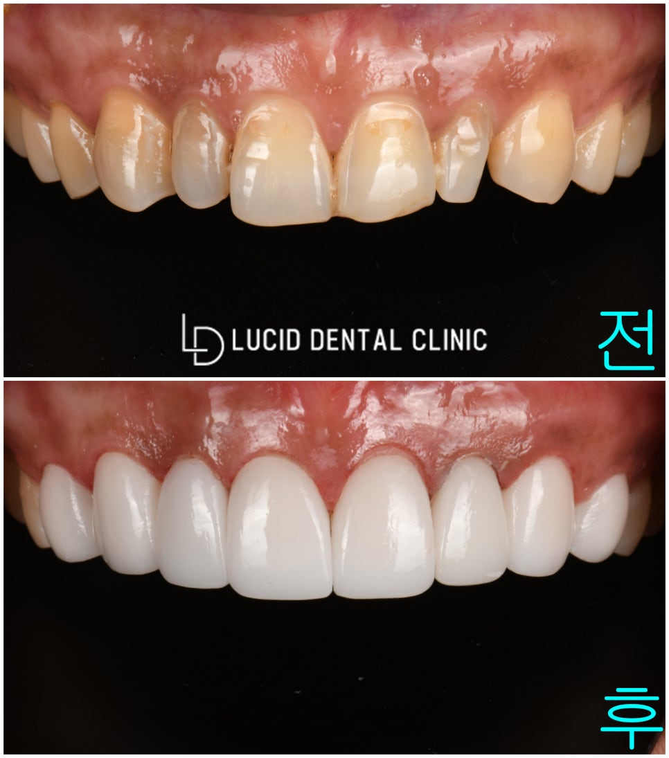 신논현역 치과 왜소치 최소 삭제 라미네이트 치료 후기 및 주의 사항 관련 이미지 3