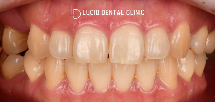 서초동 치과 "벌어진 앞니 사이에 생긴 까만 점, 정체는?" 라미네이트 치료 후기 (feat. 치간 이개 Diastema) 관련 이미지 1