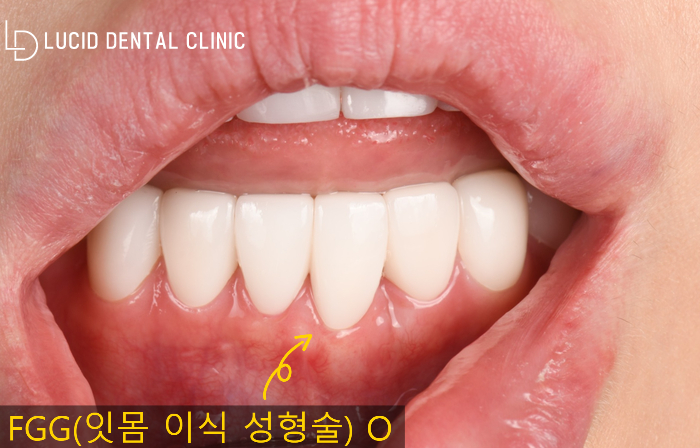 강남역 치과 추천 -  잇몸 염증으로 심하게 내려간 아래턱 앞니 치아, FGG(이식 성형술) 동반한 라미네이트 시술 후기 관련 이미지 6
