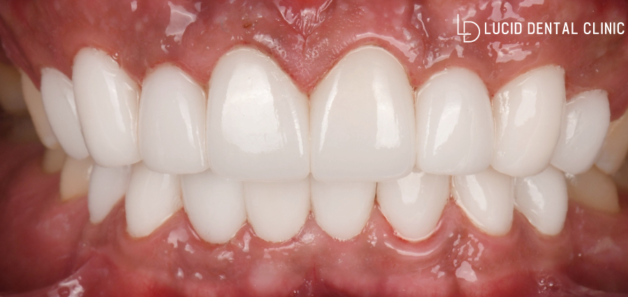 논현역 치과 치아교정없이 틀어진 앞니 토끼이빨 배열 개선 가능한 루시네이트 시술 후기 관련 이미지 3
