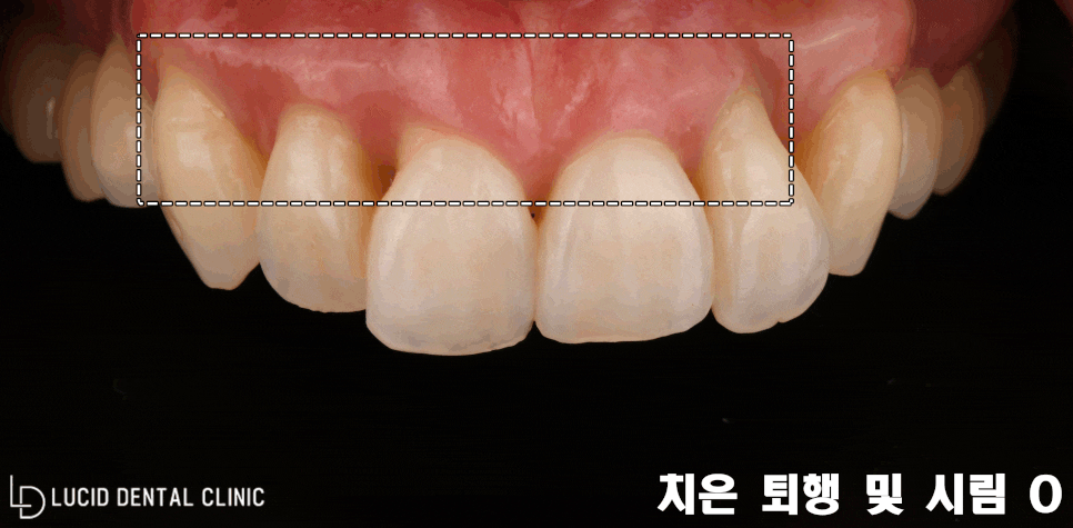 틀어진 앞니 & 치아 시림, 역삼역 치과 원데이 루시네이트로 하루만에 개선할 수 있습니다. 관련 이미지 3