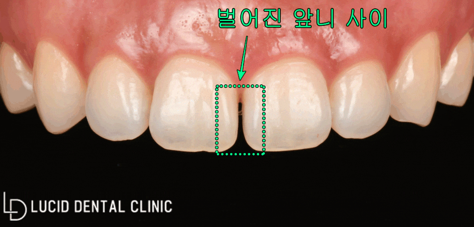 서초동 치과 - 벌어진 앞니 치아, 최소 삭제 라미네이트 시술 로 하루 만에 달라질 수 있습니다. 관련 이미지 1