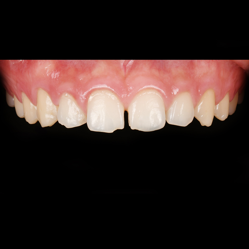 If you want to improve gapped and chipped front teeth, consider Lucinate image 1