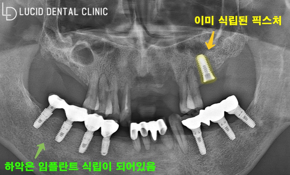 선정릉역 임플란트 로 교합되지 않던 치아를 개선해 드린 이야기 관련 이미지 1