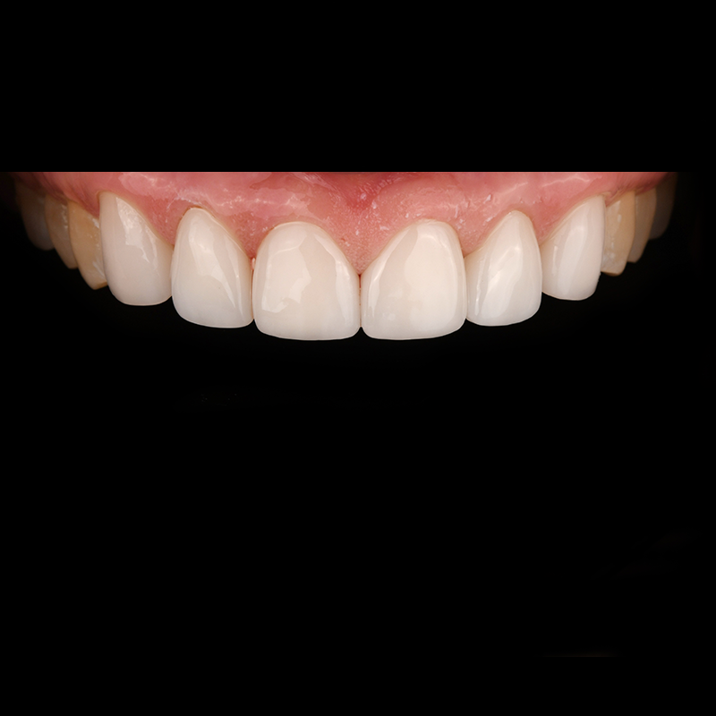 Can Cracked and Stained Front Teeth Be Improved Naturally? image 2