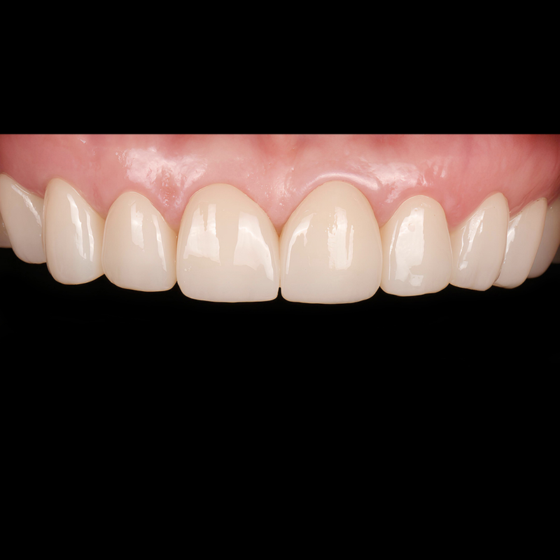 A Case of Naturally Improving Gapped Teeth with Lucinate at Yeoksam Dental Clinic image 2
