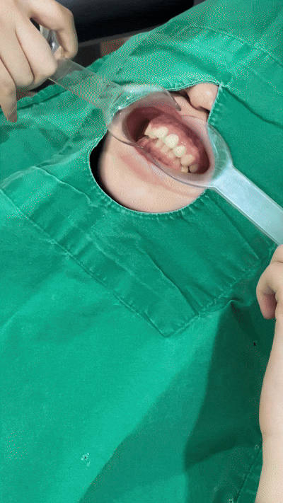 치아변색, 앞니 라미네이트가 필요한 경우ㅣ논현동치과 관련 이미지 6