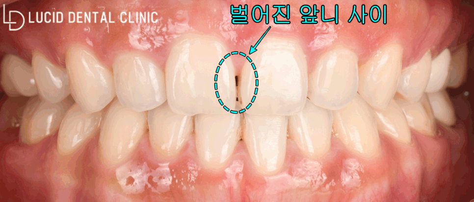 "앞니 치아 사이가 벌어져서 안 예뻐요!" 역삼동 치과 하루만에 예뻐지는 루시네이트 시술 후기 관련 이미지 3