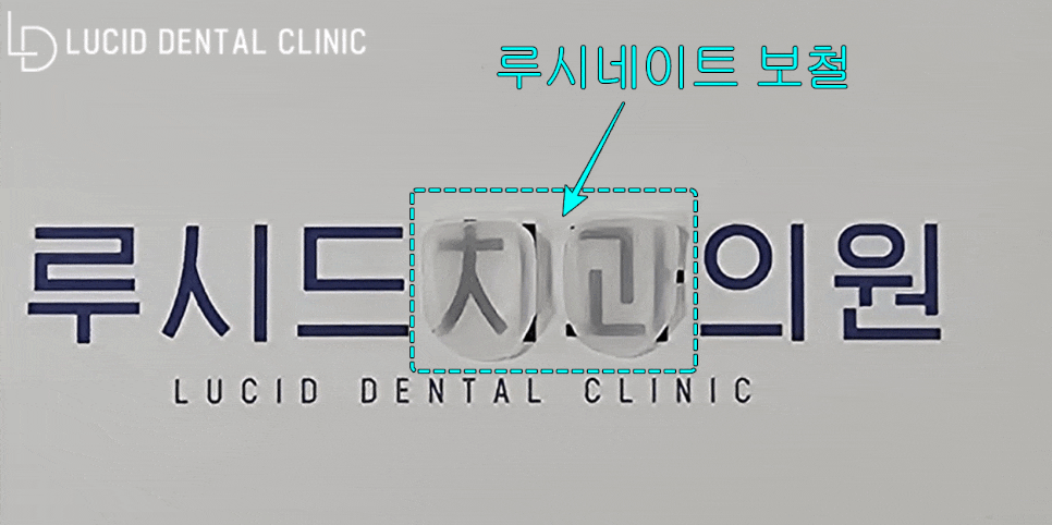 "앞니 치아 사이가 벌어져서 안 예뻐요!" 역삼동 치과 하루만에 예뻐지는 루시네이트 시술 후기 관련 이미지 6
