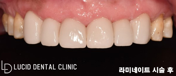 심각한 치아 변색과 마모증, 논현역 치과 에서 라미네이트 로 치료가 가능한 곳은? 관련 이미지 3