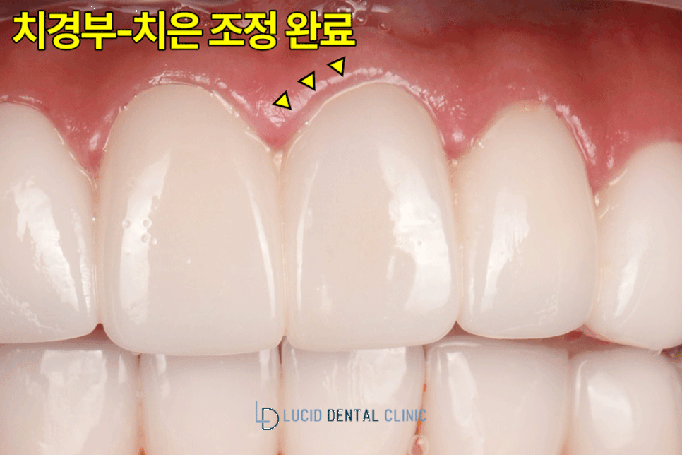 논현동 치과 에서 교정 없이, 라미네이트 시술 로 뻐드렁니 개선해 드린 사례 관련 이미지 6