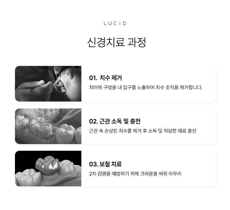 If You’re About to Receive Root Canal Treatment at Seonjeongneung Station Dental Clinic image 4