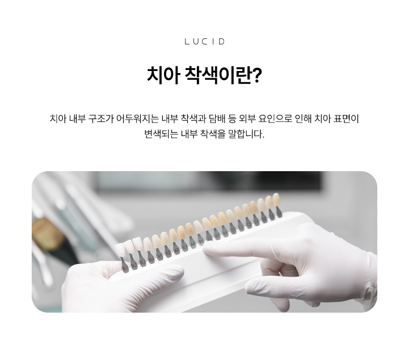 Tooth Discoloration Management at Samsung Jungang Station Dental Clinic image 2