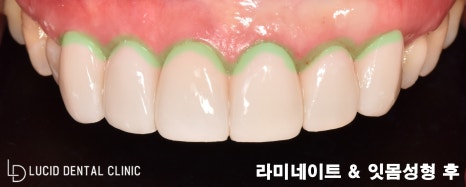까맣게 변색된 치아, 강남역 치과 에서 라미네이트 로 해결 가능합니다! 관련 이미지 5
