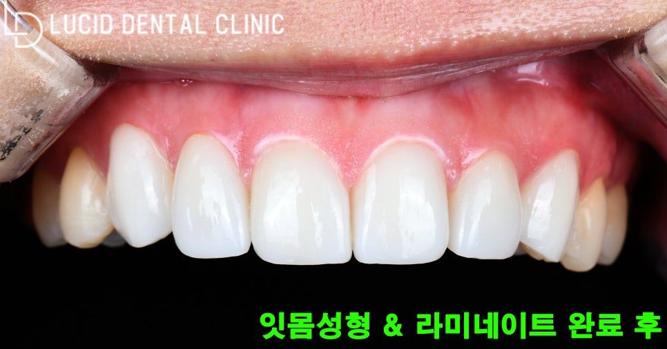 역삼역 라미네이트 와 잇몸성형으로 자신감을 되찾은 이야기 관련 이미지 3