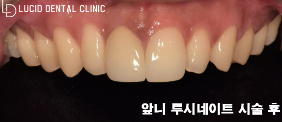 벌어진 앞니 사이 고민, 선정릉역 치과 에서 라미네이트 받고 날려버리세요! 관련 이미지 3